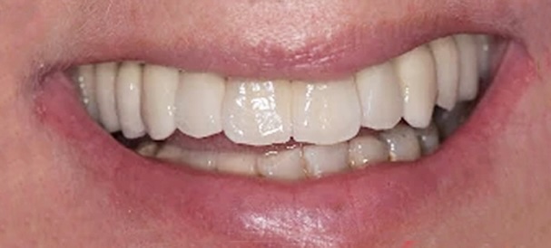Implant-Supported Dental Bridges 2 After