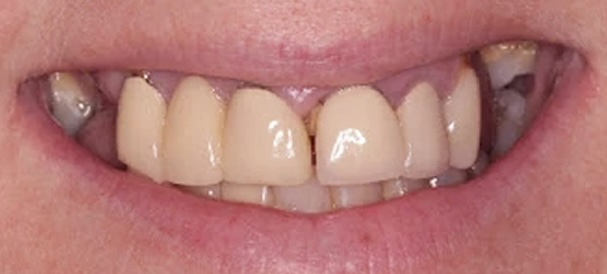 Implant-Supported Dental Bridges 2 Before