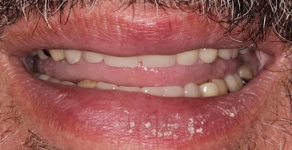 Partial Dentures 1 After
