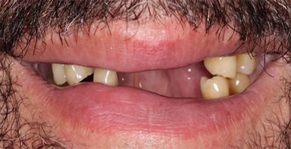Partial Dentures 1 Before
