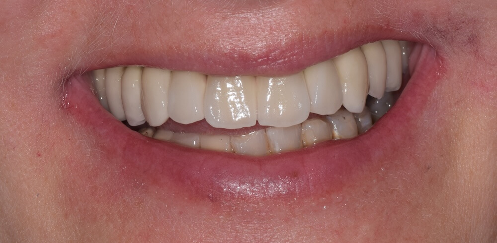 After