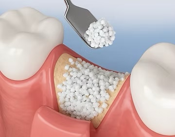 Bone Graft in Rochester, NY