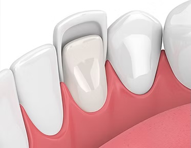 Dental Veneers in Rochester, NY