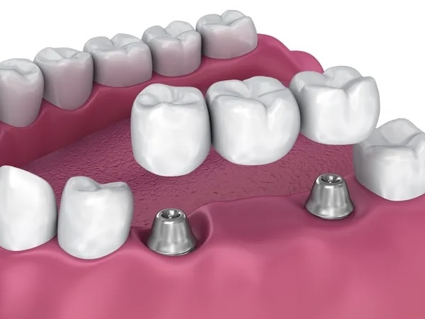 Implant-Supported Dental Bridge