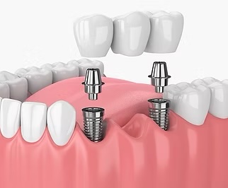 Implant-Supported Dental Bridge in Rochester, NY