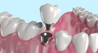 Implant-Supported Dental Crowns in Rochester, NY