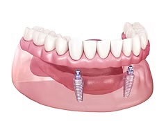 Overdentures