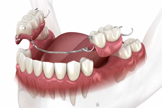 Partial Dentures in Rochester, NY