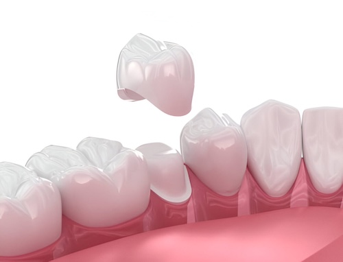 Dental Crowns in Rochester, NY