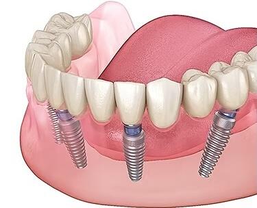 Dental Implants